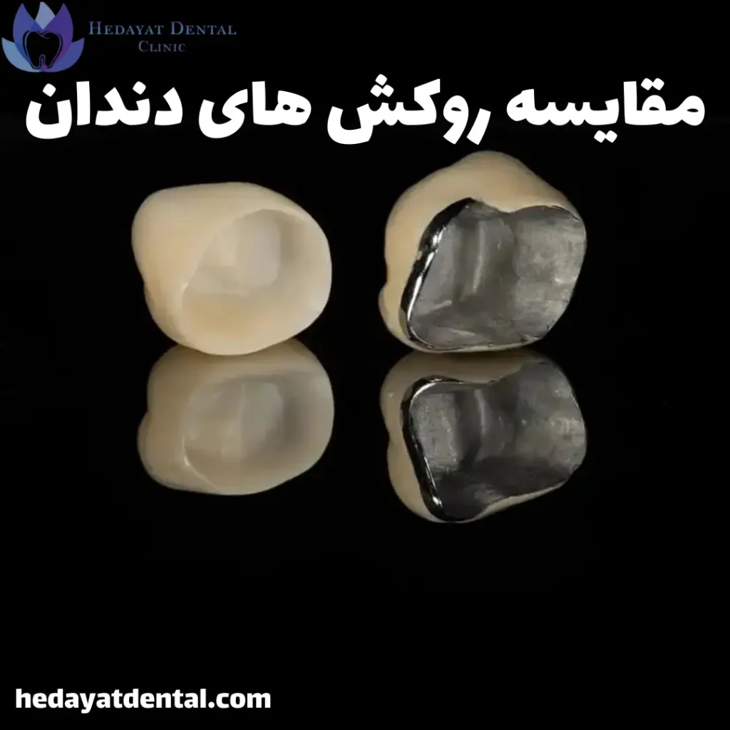 روکش دندان PFM