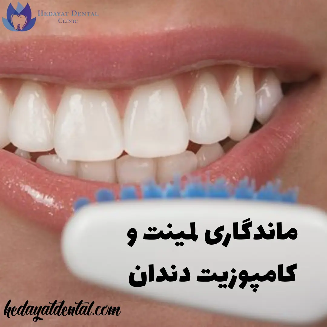 صفحه اصلی 16 ۷ نکته برای افزایش ماندگاری لمینت و کامپوزیت دندان