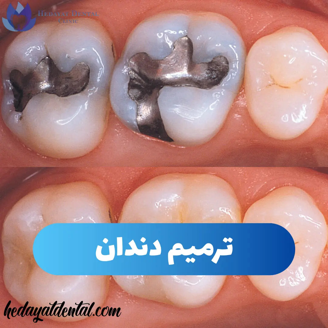 صفحه اصلی 14 ترمیم دندان یا پرکردن چیست؟