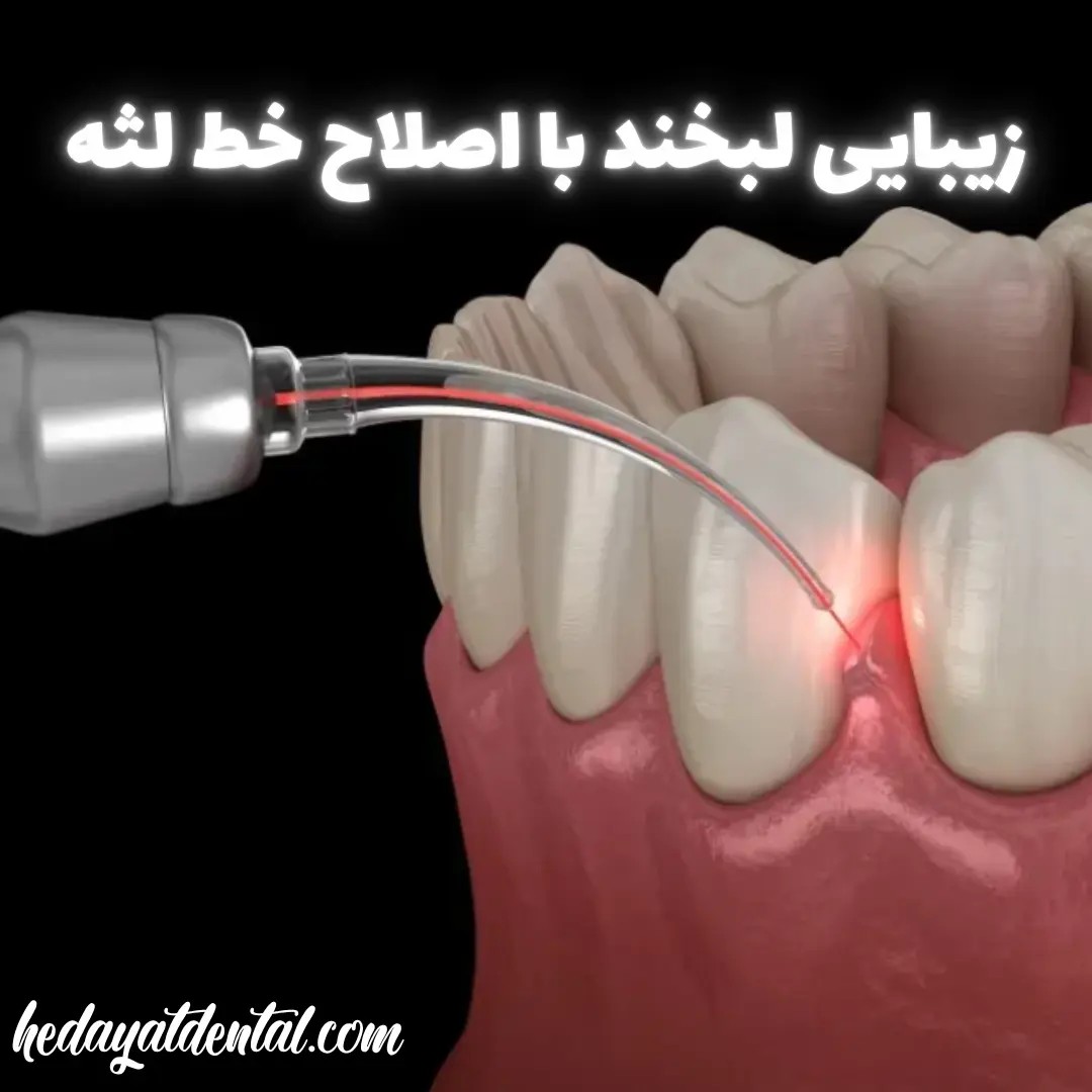 صفحه اصلی 15 زیبایی لبخند با اصلاح خط لثه